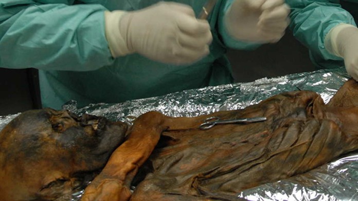 Otzi helicobacter pylori Otzi helicobacter pylori