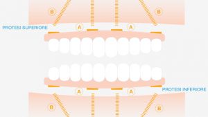 protesi all-on-4 Hospitadella