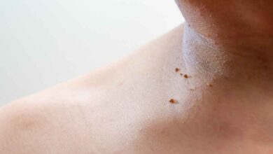 alcuni fibromi penduli sul collo di un uomo