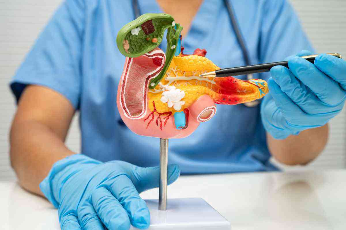 un medico utilizza un modellino in plastica della cistifellea per spiegare la colecistite