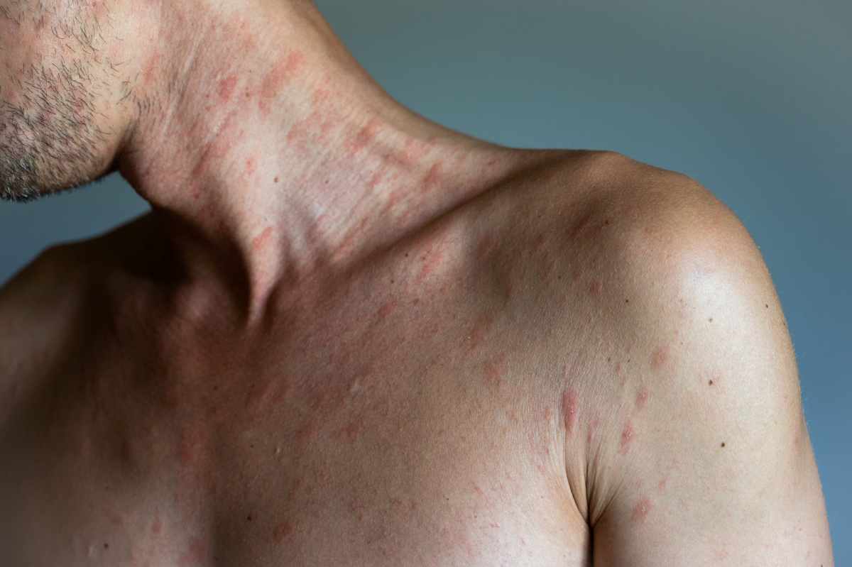 spalle e collo con orticaria