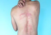 una schiena con orticaria