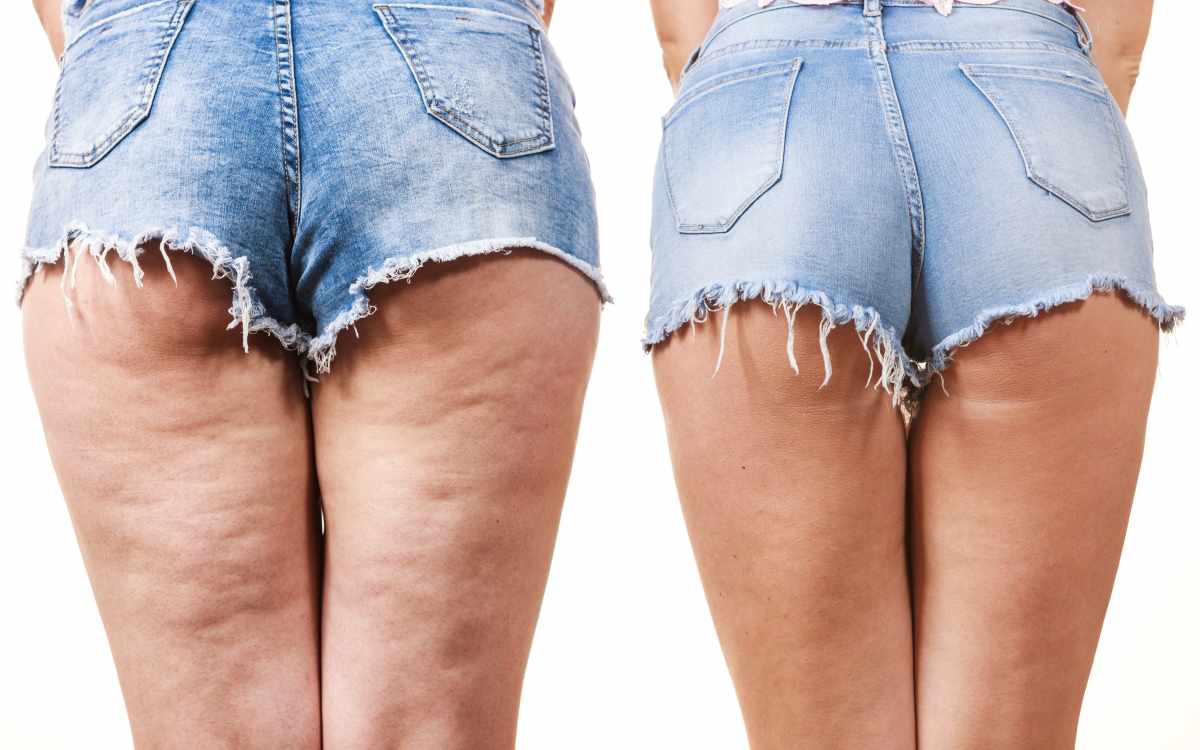 Confronto delle cosce delle gambe femminili con e senza cellulite. Problema di pelle, cura del corpo, sovrappeso e concetto di dieta.