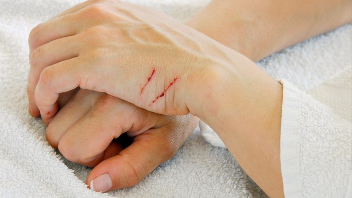 Attenti Ai Graffi Dei Gatti Il Rischio Può Essere La Bartonellosi