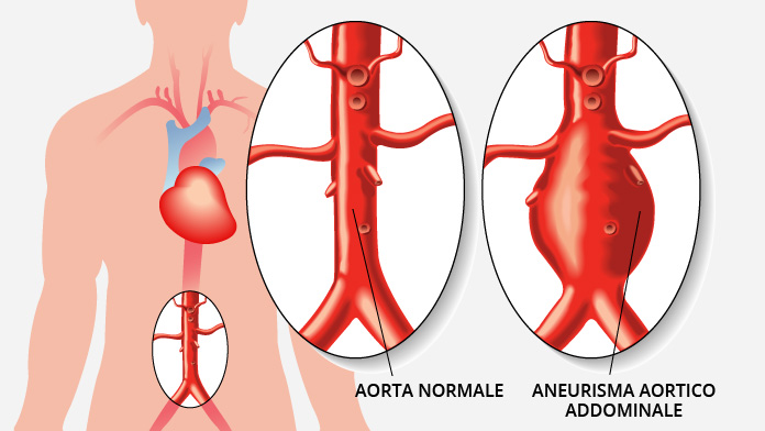 aneurisma