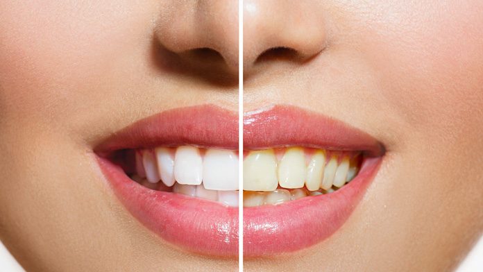 Sbiancamento dei denti: quando e come farlo