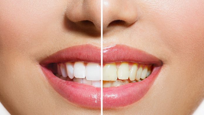 Sbiancamento dei denti: quando e come farlo Sbiancamento dei denti: quando e come farlo