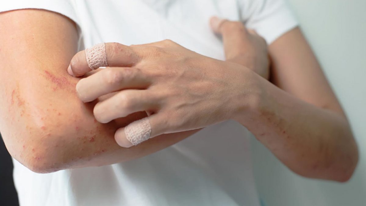 Orticaria Quali Sono Le Cause Come Si Cura Ok Salute