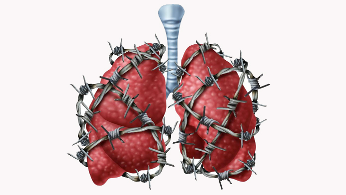 Enfisema