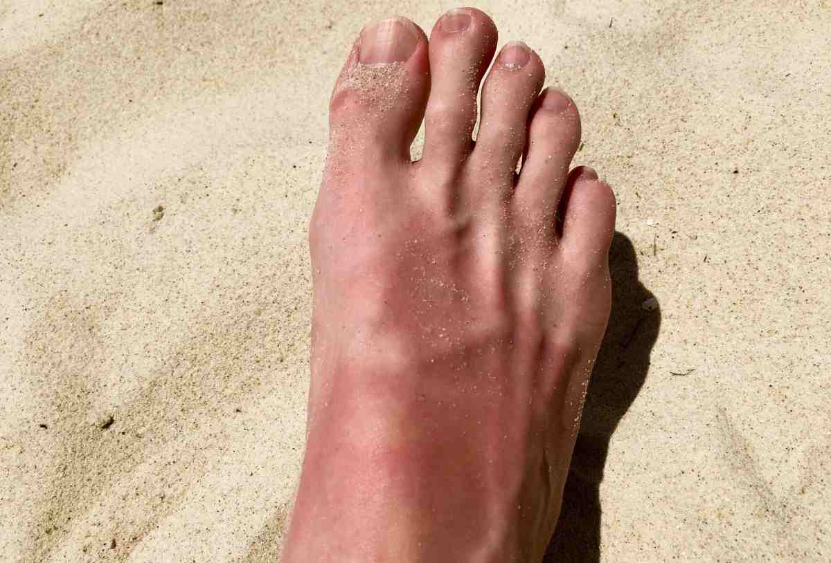 un piede bruciato dal sole