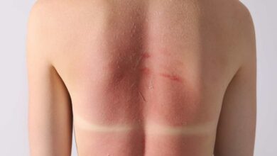 la schiena di una donna che ha la pelle bruciata dal sole