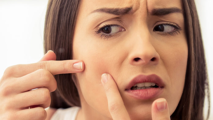 rimedi per acne da stress