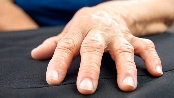 Artrosi alle mani: sintomi e cura - Algosfree – Algos Free