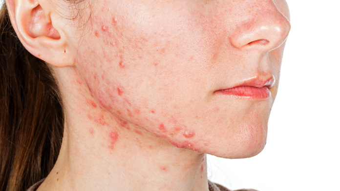 curare le cicatrici da acne