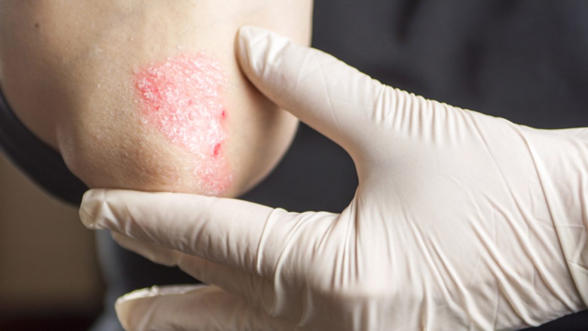 Psoriasi Tutto Quello Che C E Da Sapere Ok Salute