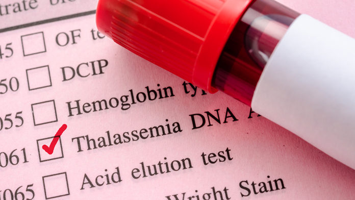 Beta talassemia Beta talassemia