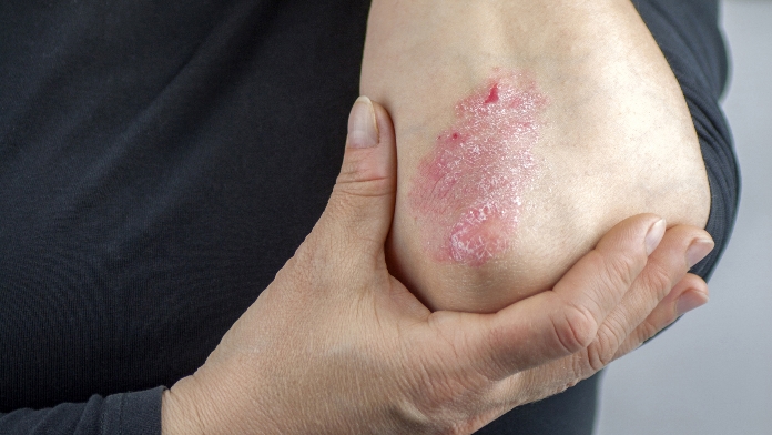 Artrite psoriasica