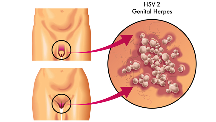 herpes genitale