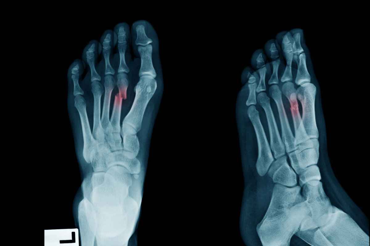 una lastra che mostra la frattura di due dita dei piedi di un paziente