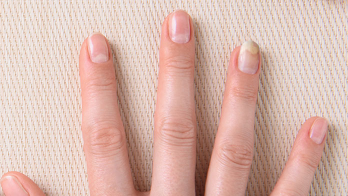 Distaccamento delle unghie