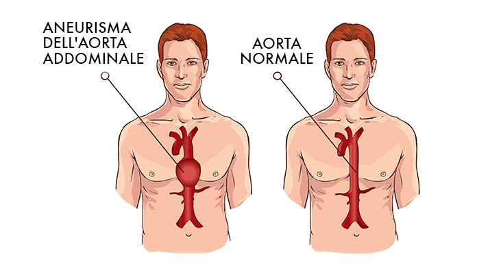 aneurisma dell'aorta addominale