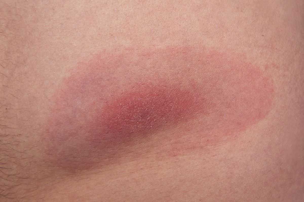 eritema tipico della malattia di lyme
