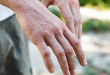 psoriasi cure termali