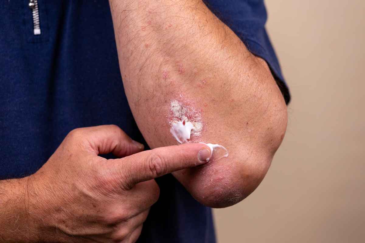 un paziente con psoriasi si spalma una pomata sull'avambraccio