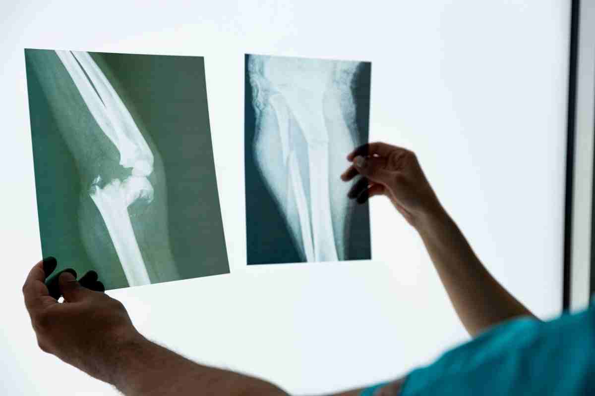 un medico esamina una lastra per verificare la presenza di osteoporosi
