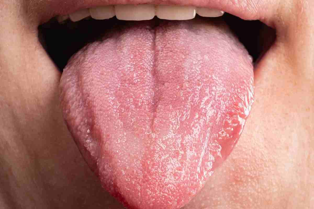 un paziente mostra la lingua per diagnosi di secchezza delle fauci