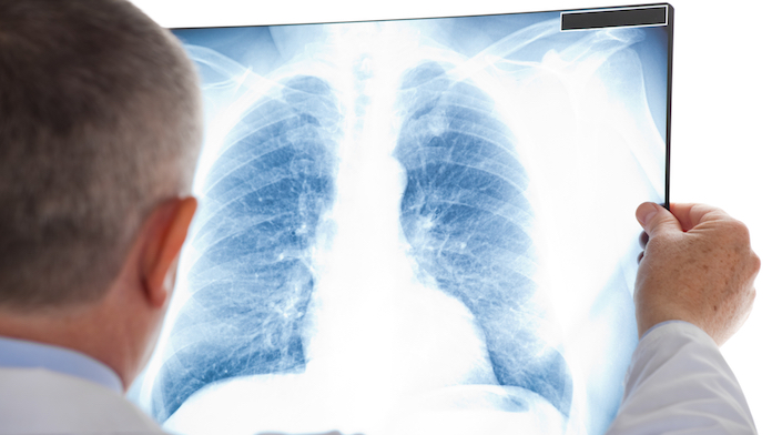 Screening del tumore al polmone