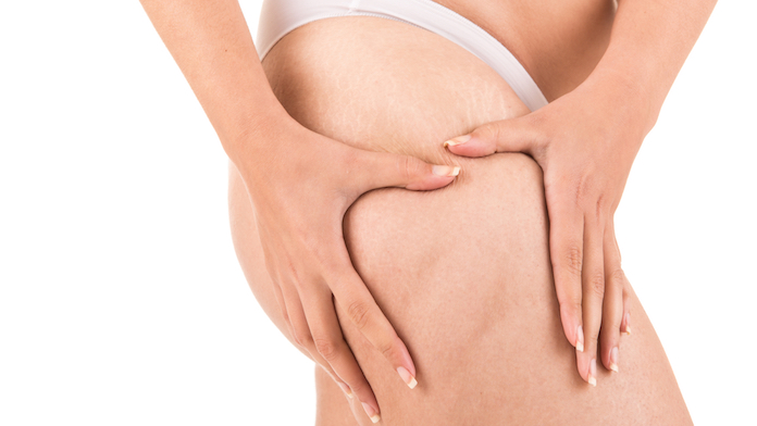 cellulite ha un ruolo protettivo sulla salute