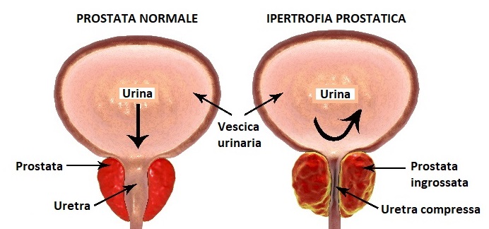 Prostata normale e ipertrofia prostatica benigna