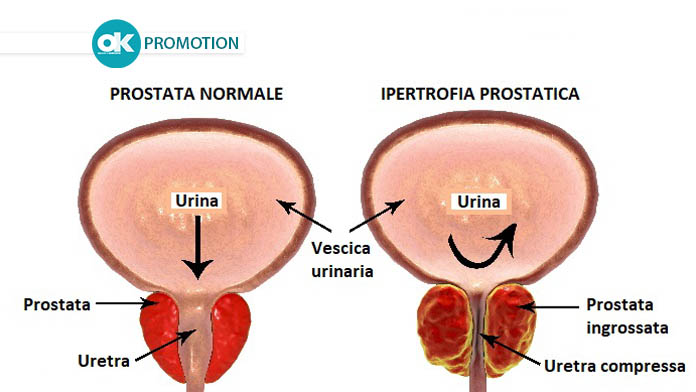 Ipertrofia prostatica: il robot riduce il volume della prostata, mantenendo l'eiaculazione