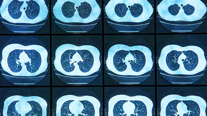 radiografia - Ipertensione polmonare: una campagna per anticipare la diagnosi radiografia - Ipertensione polmonare: una campagna per anticipare la diagnosi
