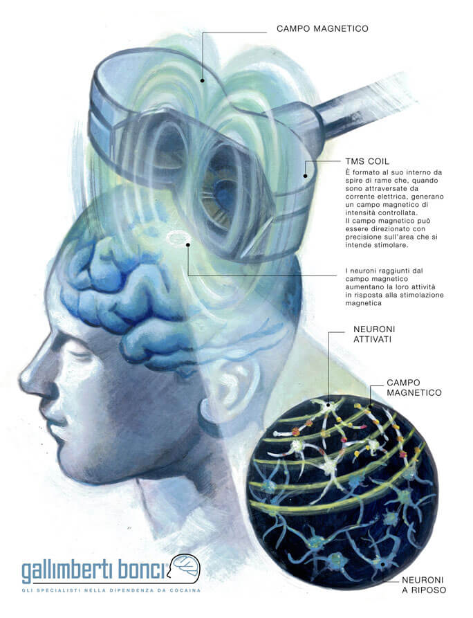 Stimolazione magnetica transcranica - TMS