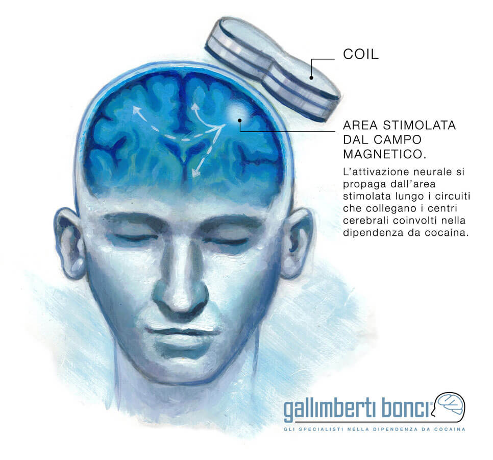 Stimolazione magnetica transcranica - TMS