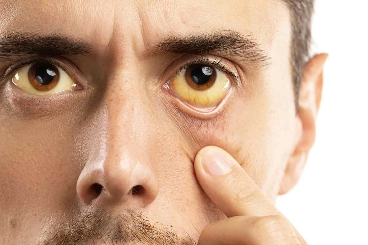 un uomo con la sclera gialla