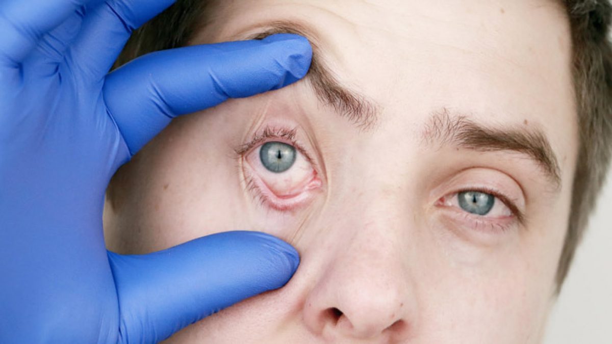 Le Malattie Che Si Possono Vedere Dagli Occhi Ok Salute Le Malattie Che Si Possono Vedere Dagli Occhi Ok Salute