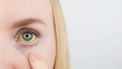 una donna con la sclera gialla
