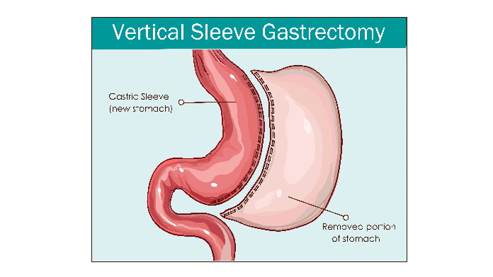 Sleeve gastrectomy tradizionale