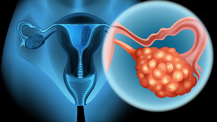 tumore ovarico