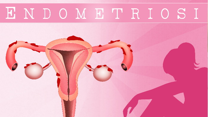 endometriosi