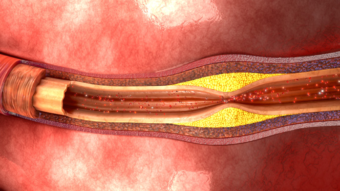 pulire le arterie dal colesterolo