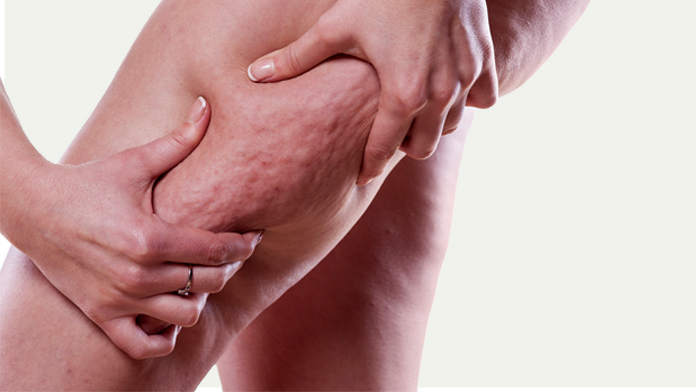 cellulite e ritenzione idrica