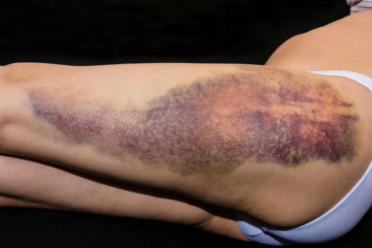 donna che presenta un livido scuro molto esteso sulla coscia