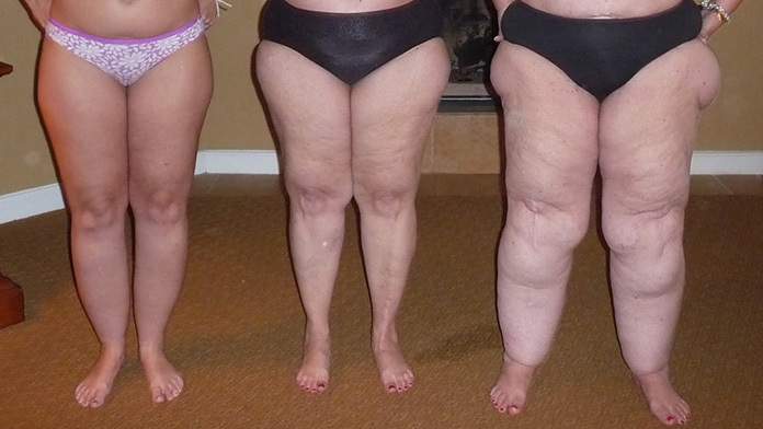 lipedema