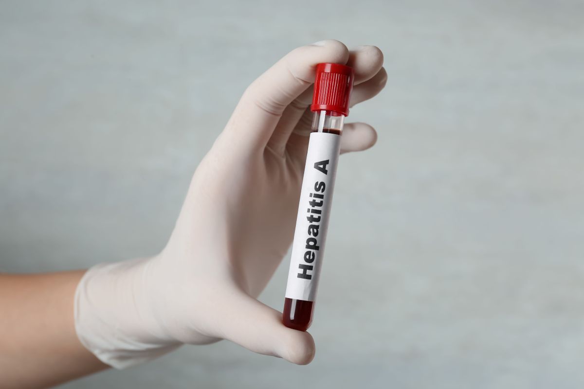 una fiala con la scritta hepatitis a contenente un campione di sangue