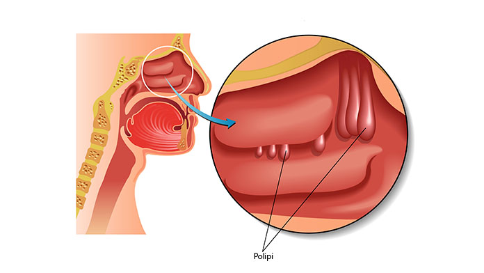 poliposi nasale