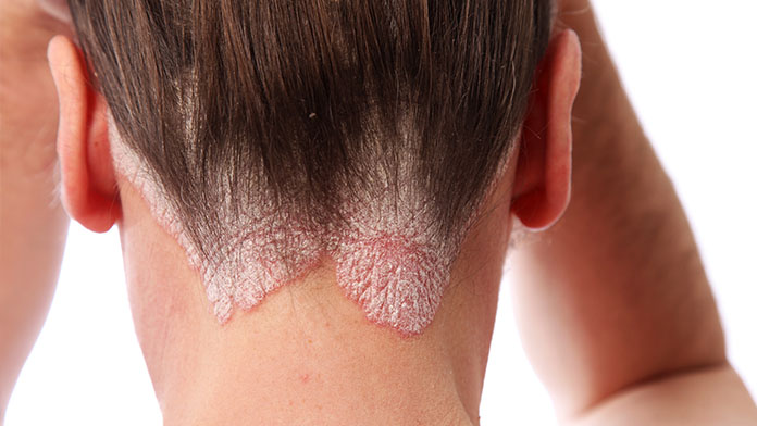 nuovo farmaco psoriasi